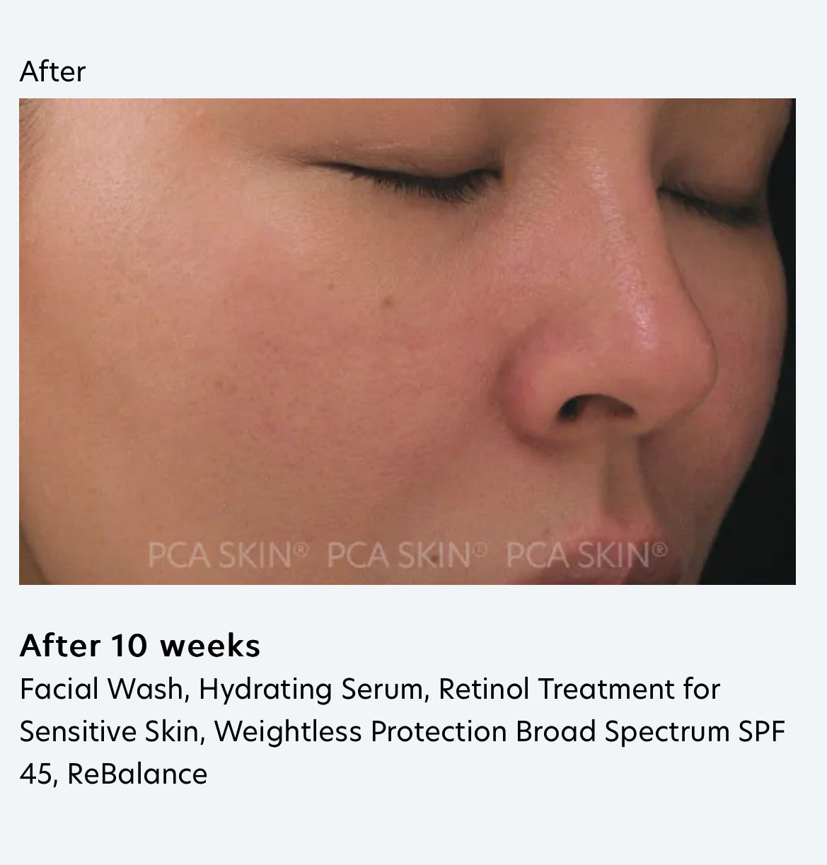 Retinol Treatment for Sensitive Skin